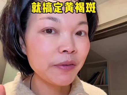 过来人实话:淡斑真不用花大价钱!
维生素E坚持涂,黄褐斑真的会慢慢淡。
几十年亲身验证,安全又实在。
有斑的姐妹,不妨试试这个老方法。
#淡斑 #简单护肤 #维生素E #护肤干货 #生活小妙招