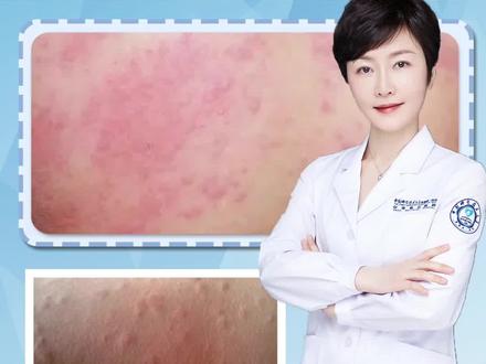 受热皮肤起疙瘩?胆碱能荨麻疹很特殊 #医学科普 #皮肤科 #荨麻疹