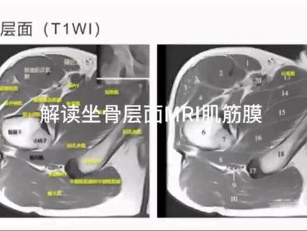 坐骨平面MRI肌筋膜 坐骨是髋骨的一部分,位于骨盆的后下部。在坐骨平面,周围有丰富的肌肉、筋膜等软组织。其中,臀大肌、臀中肌、梨状肌等肌肉附着于坐骨及周围结构,这些肌肉对于髋关节的运动和稳定起着关键作用。而肌筋膜则是包裹肌肉、分隔肌肉组织并提供支持和保护的结缔组织。
在 T1 加权像上,肌筋膜通常表现为低信号,与周围中等信号的肌肉组织形成对比,可清晰显示其轮廓。在 T2 加权像上,肌筋膜仍为低信号,但如果有水肿等情况,信号可能会有所增高。例如,正常的梨状肌肌筋膜在 MRI 图像上是围绕梨状肌的一层薄而连续的低信号结构,边界清晰。#在抖音pick你的健康搭子 #解锁春日健康清单 #抖出健康知识宝藏 #抖音特效达人中心