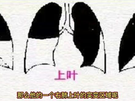 影像知识:胸片典型病例讲解,肺叶在胸片上大致区域划分