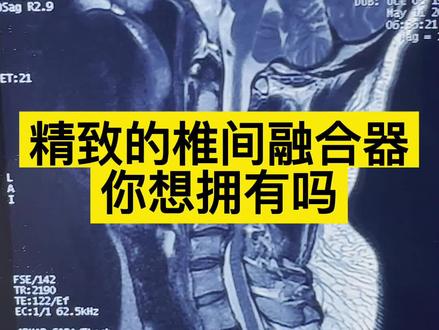 精致的椎间融合器你想拥有吗