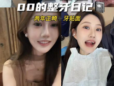 做完更爱笑了✔️#牙贴面 #整牙历程 #牙齿美白