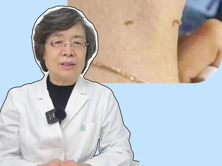 脖子或腋下长这种小肉丁,小心是HPV病毒感染!#医学科普 #皮肤 #健康 #丝状疣 #HPV