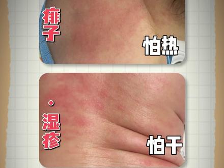 宝宝常见3种皮肤问题,一篇说清楚! #痱子 #湿疹 #新生儿痤疮 #儿童皮肤问题 #抖出健康知识宝藏