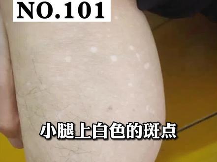 老人家腿上出现了这些白点,不用担心,其实很常见 #皮肤 #白斑