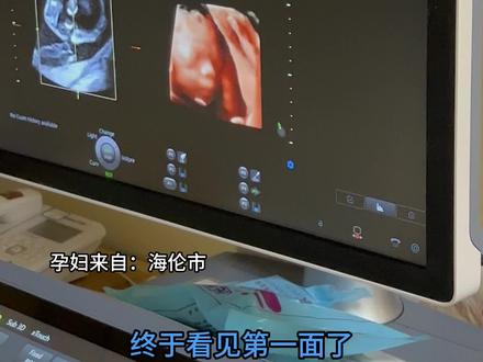 看到宝宝的瞬间母爱泛滥了!孕妈们,你们有这种感觉吗? #产检 #大排畸 #哈尔滨