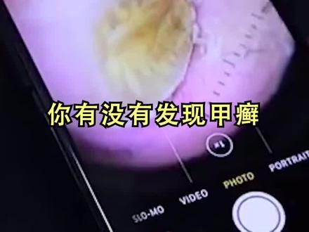 治#灰指甲 一定要坚持!