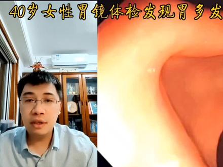 明说鑫语之40岁女性没有症状,胃镜体检发现胃多发粘膜下隆起 #明说鑫语 #消化青年论坛 #创作灵感 #胃镜 #早诊早治