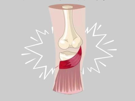 更多纠正动作在@运动康复找老孙 #广州运动康复#深圳运动康复#力线运动康复#腘肌#久站 @抖音小助手