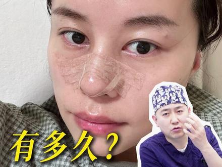 隆鼻恢复期以及术后注意事项 #医学科普 #鼻综合 #鼻修复 #隆鼻恢复