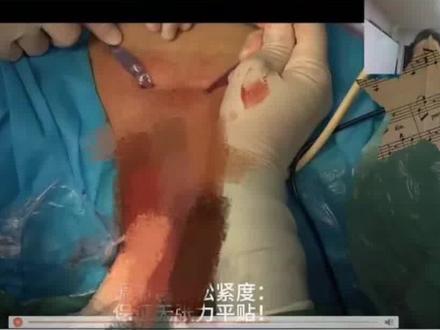 陕中附院妇科官方账号手术直播,被指暴露女患者下体隐私部位,高峰期在线达5万多人,被举报后停播。涉事医院回应:已关注到此事,正在处理中。#陕西中医药大学附属医院 #陕中附院妇二科