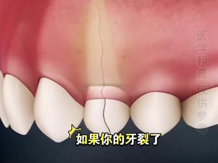 牙隐裂深入牙根,只能拔掉。
#牙隐裂 #口腔健康 #种植牙 #镶牙 #义齿