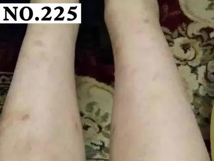 很多人被蚊子叮咬之后会留下一些难看的黑印,有的会慢慢自己消失,有的会长久的存在,怎么解决?#皮肤 #科普 #蚊子