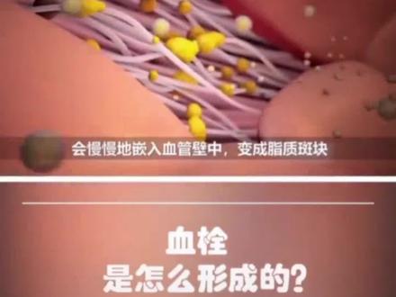 血栓是怎么形成的?#中医文化传承 #健康科普 #血栓