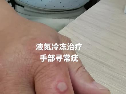 液氮冷冻治疗手部寻常疣
#有一种疼叫做看着都疼