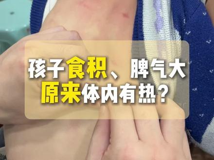 孩子食积内热 #黄建平小儿推拿 #小儿推拿手法 #积食