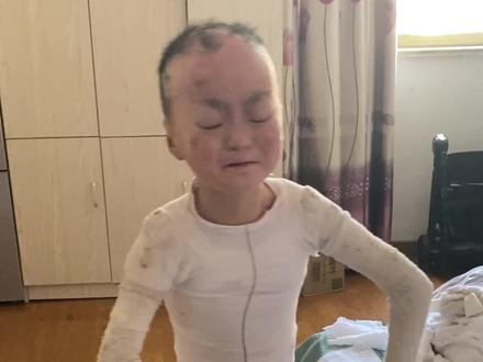 来到第一件事,就是要个晨晨洗澡换药#蝴蝶宝贝 #小屁孩的日常