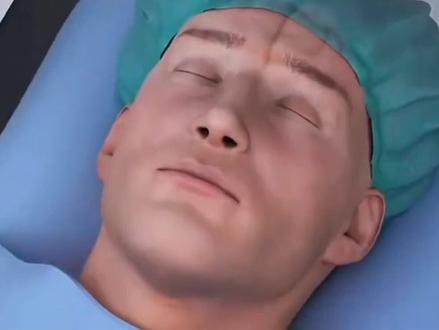 急性脑缺血发作,介入脑动脉取栓过程揭秘!#脑供血不足 #神经介入 #微创手术