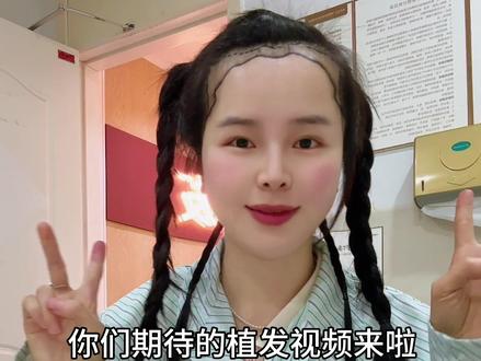 浅浅记录一下,以后你们再也看不到我的大脑门啦#植发 #发际线
