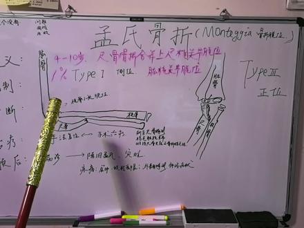 孟氏骨折别漏诊;后患无穷需谨慎。