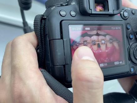 戴了牙套之后,黑三角有点严重,牙套哥最近去拜访了几个专业的牙医,完整记录给你们!#牙齿黑三角 #牙龈萎缩 #牙齿矫正 #正畸 #牙齿正畸