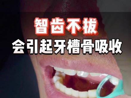 智齿不拔,会引起牙槽骨吸收#智齿 #健康科普