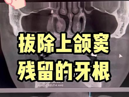牙根脱落进入上颌窦最后成功取出#武汉口腔医生孙明宇