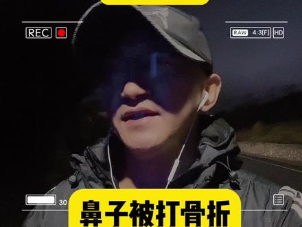 咨询分享】鼻骨骨折,是否能赔十万?
鼻骨骨折,只是轻微伤,只有粉碎性骨折才是轻伤二级。
依据《人体损伤程度鉴定标准》属于轻伤二级:鼻骨粉碎性骨折;双侧鼻骨骨折;鼻骨骨折合并上颌骨额突骨折;鼻骨骨折合并鼻中隔骨折;双侧上颌骨额突骨折。
#鼻骨 #轻伤 #故意伤害