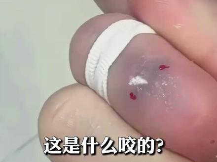 只需15秒!医生教你认清虫咬 正确处理#虫咬