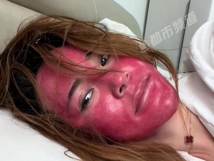 惊了!37岁女子长期化妆不卸妆皮肤红成“关公”过敏严重!@牛又面 #万万没想到 #社会百态 #奇闻奇事 #女性