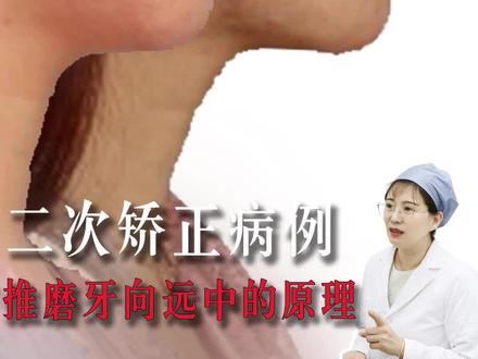 1、牙齿牙根在上颌窦里面?2、牙槽骨后面没有空间?3、推了后牙根会倾斜?所以不能推磨牙向远中?
拿个二次矫正的案例,来分析一下能不能推磨牙向远中#牙齿矫正 #推磨牙向后 #正畸 #佛山牙齿矫正 #佛山正畸