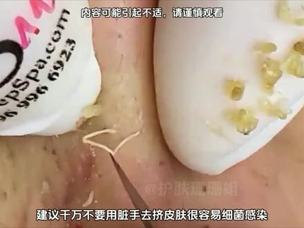 宝子们这期格外的饱满#护肤 #痘痘黑头粉刺拜拜 #细胞夹面部清理工具 #深层毛孔清洁 #解压