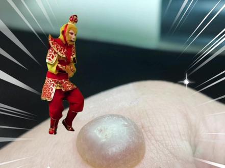 液氮冷冻治疗疣后~
水泡大、大、再大、还大…砰!!!