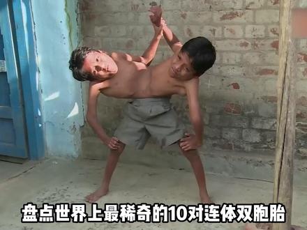 全世界最稀奇的10个连体人,姐妹俩共用1个身体,却爱上不同男人 #连体人双胞胎 #罕见 #盘点系列 #世界之最