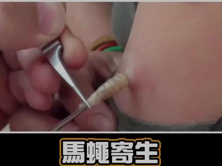 女子手臂被马蝇寄生!看医生如何将它夹出来!不可思议!#寄生虫 #马蝇幼虫 #强迫症必看 #解压
