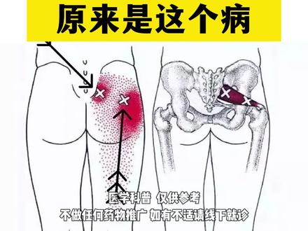 单边屁股痛腰痛是什么原因?#健康 #科普 #腰痛腿疼