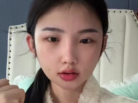 恢复期比较长,前期状态会不稳定,肿胀期很久,比较玻璃心,接受不了的宝宝们不建议去哦,过程太长了,#磨骨三件套 #分享 #变美过程