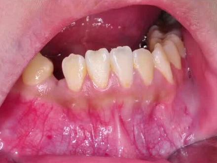 12岁小姑娘“牙瘤”占据尖牙萌出通道,造成43低位骨埋伏阻生:局麻,唇侧开窗,避开颏孔及邻牙牙根,分牙取出43及牙瘤。12分钟结束拔牙#口腔健康 #医学科普 #牙医日常