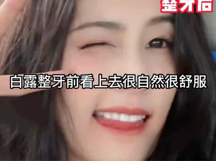#白鹿 #整牙 #变美变瘦变好看 真的变化很大吗?你觉得呢?