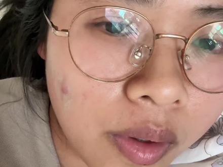 最近听说一家得红眼病得很多,都是一开始孩子症状不明显,导致一家人交叉感染,你们那里出现了吗?#真实生活分享计划 #内容太过真实 #红眼病#结膜炎 #红眼病对视会传染吗