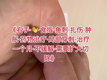 鱼刺扎伤手指感染不容易愈合、出现化脓要及时治疗需要引流彻底#鱼刺#鱼刺扎伤#手指#感染#炎症#指头炎#脓性指头炎#伤口#换药#手外伤#医生#医者仁心#医学科普#医学知识#科普#医学#手外科#武汉协和医院#武汉协和医院李涛#抖音#抖音小助手#dou#康复#鱼刺#手刺伤#开启健康2023#甲沟炎#手