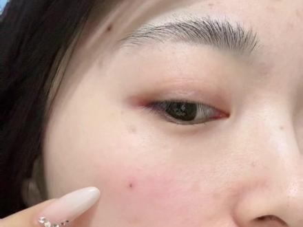 点痣切痣一个月了,恢复状况良好,没有更新的日子就是在好好护理伤口,如果有变化会再更新,请大家耐心等待#点痣 #经验分享 #谨遵医嘱 #切痣 #自我认可