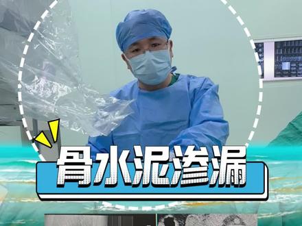 钓最“硬”的鱼! 阿姨腰椎骨折行骨水泥手术,出现骨水泥渗漏压迫神经,钓鱼佬轻松搞定!#骨水泥 #渗漏 #压迫神经 #钓鱼佬#钓鱼