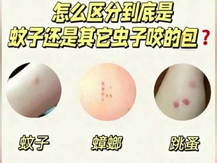 蟑螂会咬人?!教你区分不同虫子咬过的包长什么样!#蟑螂咬人 #虫咬皮炎的症状 #涨知识