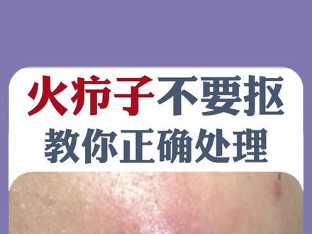 长了#火疖子又肿又痛,千万别用手挤,有人为此进ICU,教你正确处理!#医学科普 #皮肤 #希望能帮到你