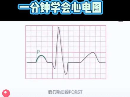 一分钟学会心电图 #重症监护室 #护士懂护士 #正能量 #上热门🔥 #心电图