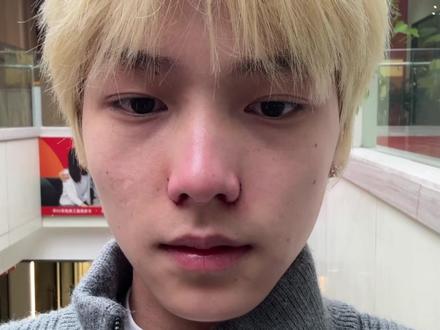 一个月缩鼻翼记录~ 终于告别大鼻头了,开心#缩鼻翼 #鼻子 #颜值