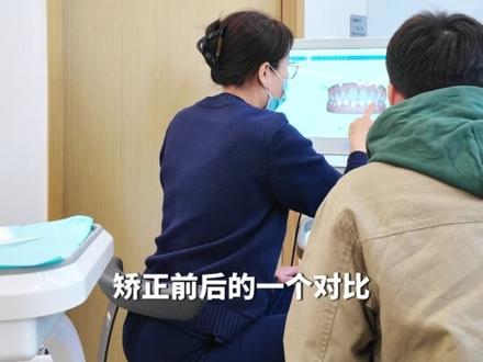 深覆盖 + 牙乱,矫正怎么显下巴? #牙齿 #牙齿正畸 #牙齿矫正 #深覆盖
