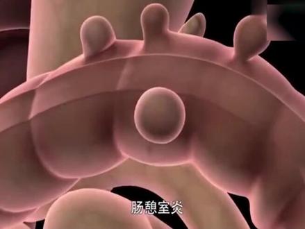 结肠切除手术一览,其实没那么可怕#手术 #医学知识科普