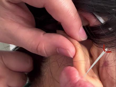 打耳洞,造成的疤痕疙瘩,复发了很多次,究竟是怎么回事儿呢??#疤痕增生 #小荷健康问专家 #关于医美那些事